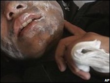 Schoolgirl in hospital after two men on a motorbike threw acid on her in Kandahar, Afghanistan, Wednesday, Nov. 12, 2008