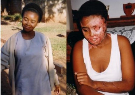 Fridah Mwansa before and after acid attack. Image: Sally Chiwama