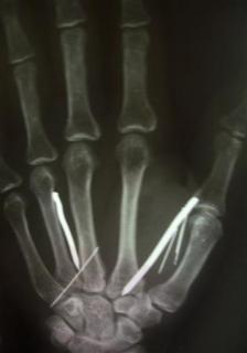 An x-ray shows nails in a hand of L.T. Ariyawathi, 49, who returned to Sri Lanka after 5 months as a maid in Saudi Arabia, in a hospital in Matara, 160 km (100 miles) south of Colombo, August 26, 2010. A Saudi couple tortured Ariyawathi after she complained of a too heavy workload by hammering 24 nails into her hands, legs and forehead, officials said on Thursday. Nearly 2 million Sri Lankans sought employment overseas last year and around 1.4 million, mostly maids, were employed in the Middle East. Many have complained of physical abuse or harassment. REUTERS/Stringer