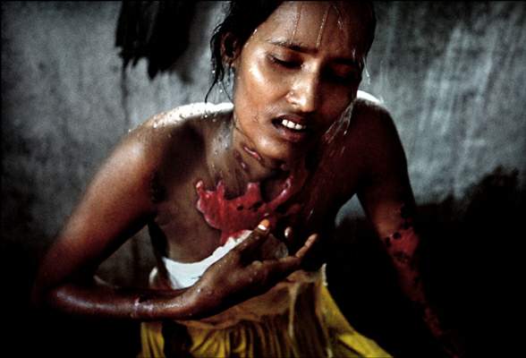 Victims of acid attacks - Bangladesh