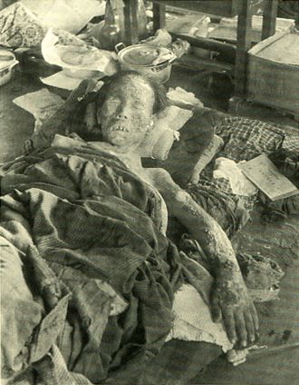 The damage of atomic bomb which Japanese Nagasaki received.   Woman suffering from burn wounds. 1945.: Nuclear